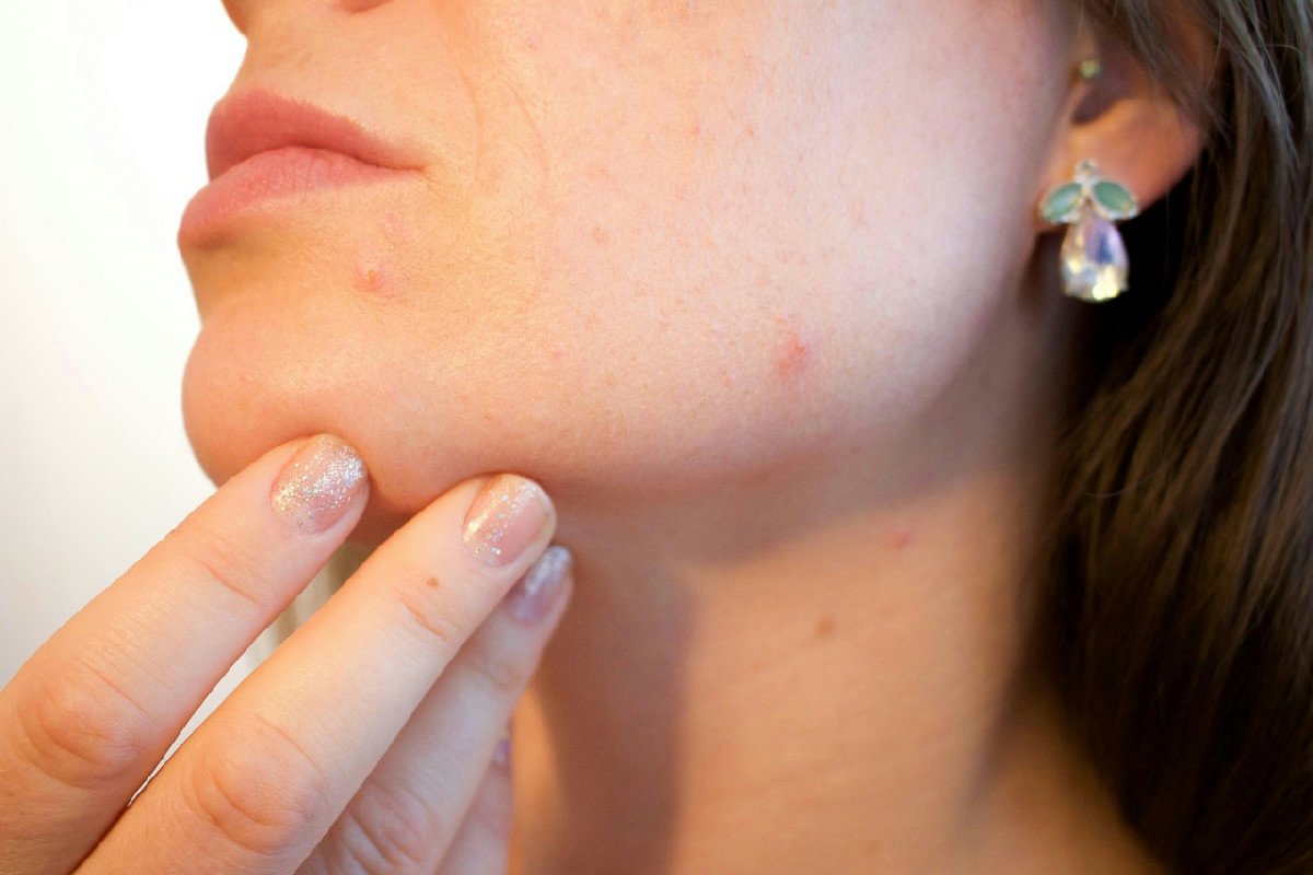 Acne e cura della pelle: 10 abitudini comuni che aumentano la comparsa dei brufoli